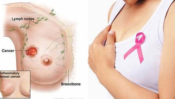 Ung thư vú là căn bệnh nguy hiểm cho sức khoẻ.