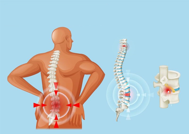 Thoát vị đĩa đệm lưng: Triệu chứng, nguyên nhân và cách điều trị